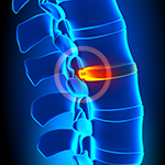 Herniated Disc