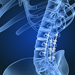 Spinal Fusion