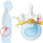 Spinal Stenosis