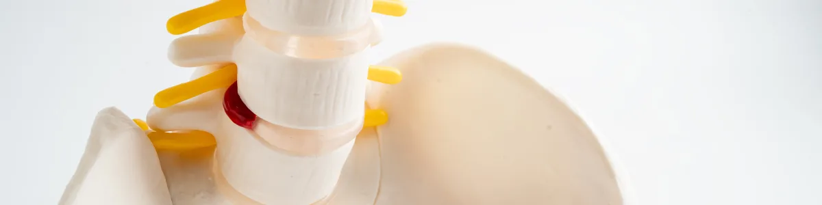 Spine model showing a herniated disc